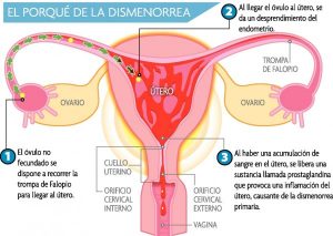 dismenorrea-dolor-menstruacion-explicacion