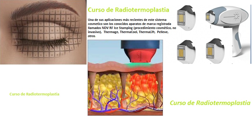 Radiotermoplastia 