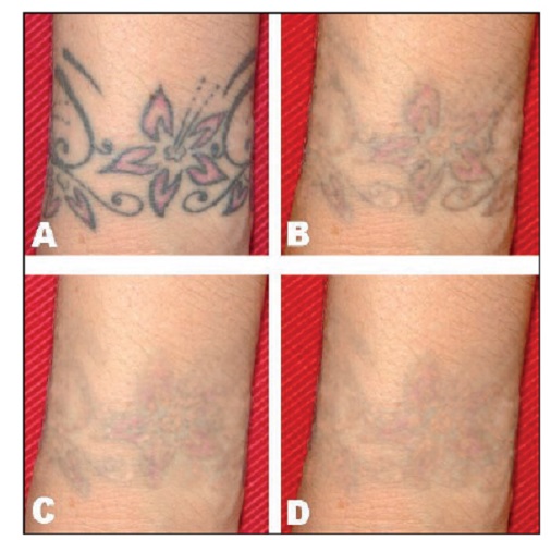 Oscurecimiento Paradójico en la eliminación / remoción de tatuajes, micropigmentaciones y maquillajes permanentes con láser