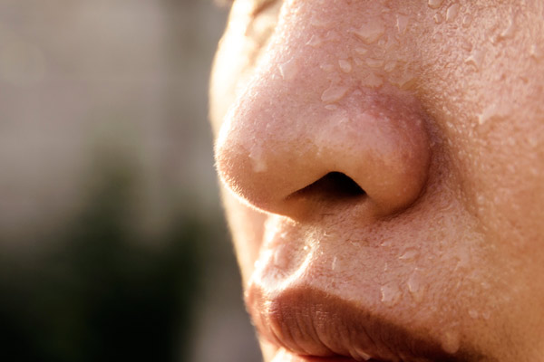 Botox en la cara para el tratamiento de la Hiperhidrosis