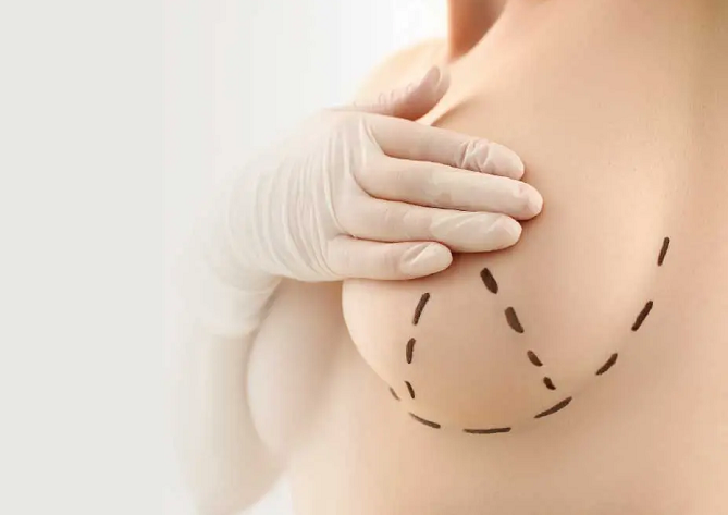 Lograr un aumento de mamas sin silicona (mastopexia o elevación de pecho sin prótesis)
