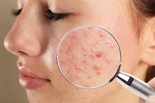 9 consejos y medidas que pueden ayudar a combatir el acné en esta época del año (Otoño)