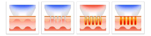 Radiofrecuencia Fraccionada o Microablación Térmica o microlesiones térmicas controladas