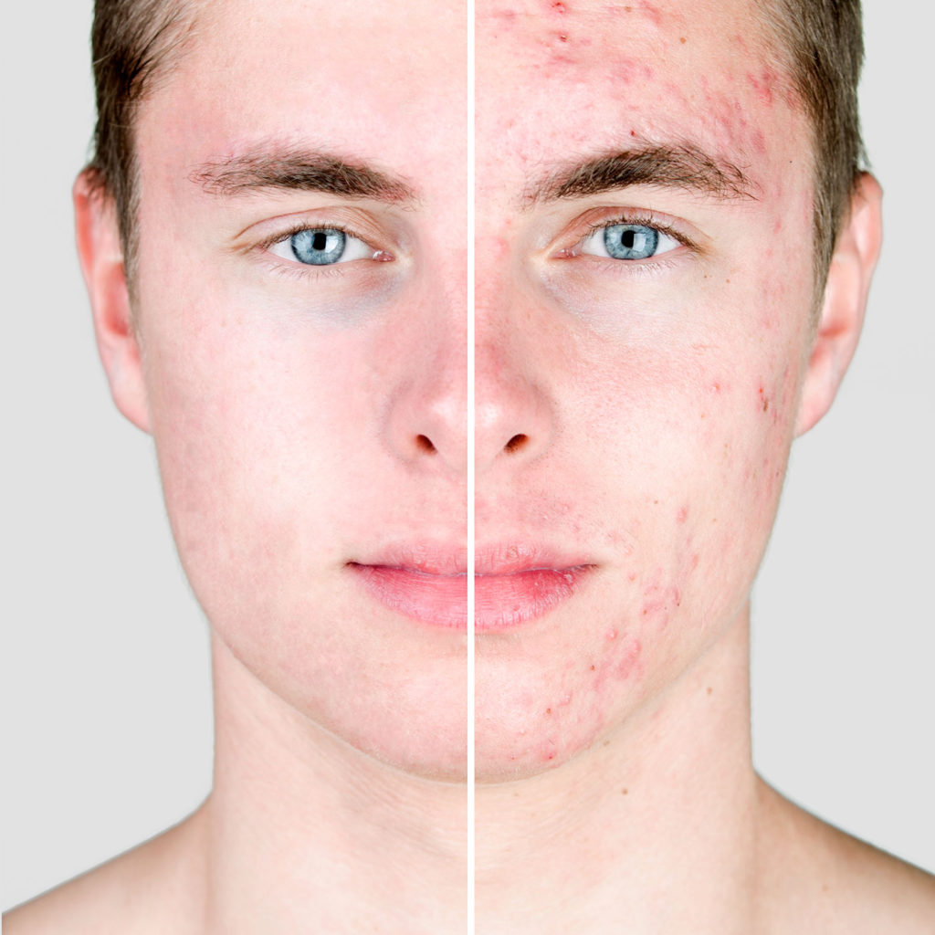 ¿Cuáles son los tratamientos más efectivos para las cicatrices del acné?